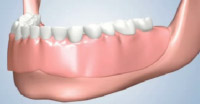 Full Lower Denture Placement