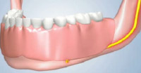 Dentures will Cause Jaw Bone To Shrink Underneath