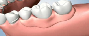 Partial Denture Sitting Over the Gums