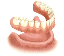 Removable Full Denture