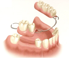 Removable Partial Dentures NYC