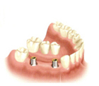 Dental Implant Supported Bridge NYC