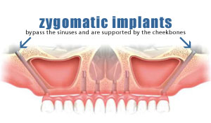 Graftless Zygomatic Implants New York City