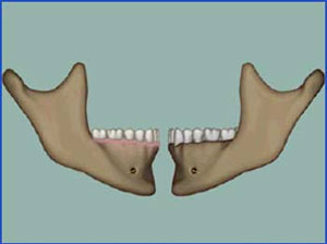 Neighboring Teeth being Prepped for Partial Bridges