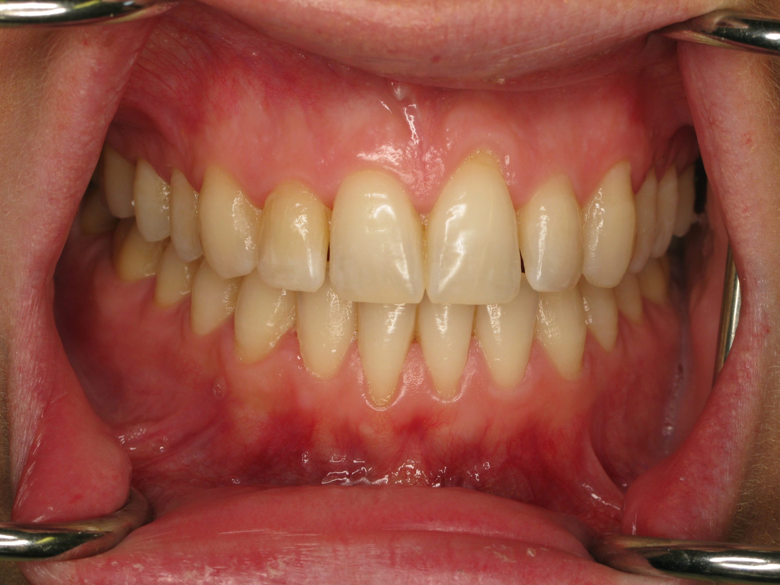 Reduced Gum Recession with Connective Tissue Graft