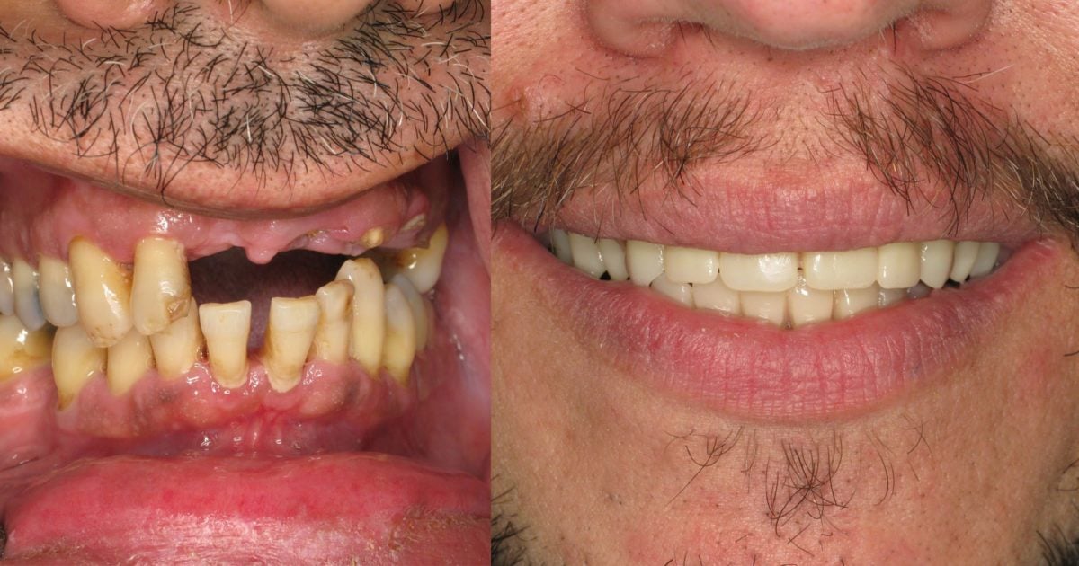 All On 4 to Treat Bone Loss Advanced Periodontics & Implant Dentistry