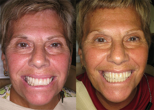 Patient Got Rid of Annoying Dentures for All On 4