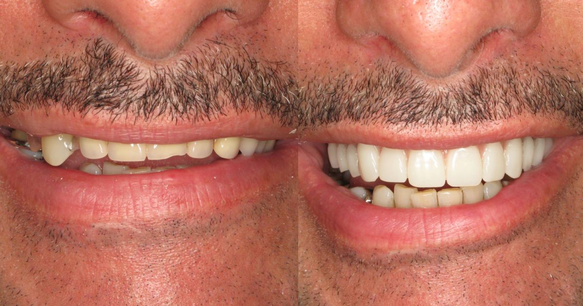 Replaced Upper and Lower Dentures with All On 4 Advanced Periodontics