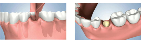Dental Implant Bone Preservation