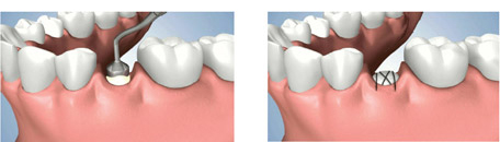 Tooth Root Replacement Process