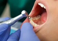 Can Dental Implants Get Infected? Understanding Risks and Prevention Image