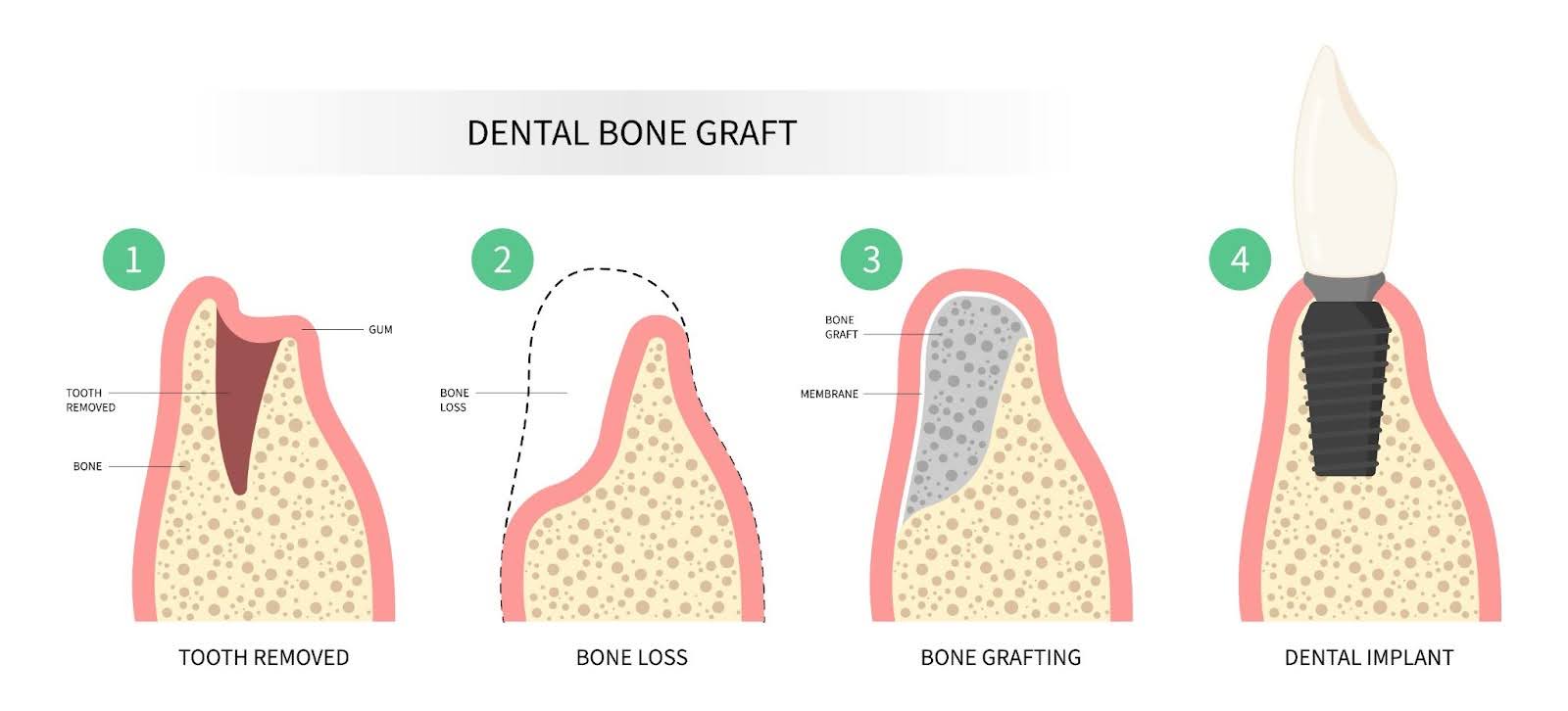 Understanding Bone Grafting