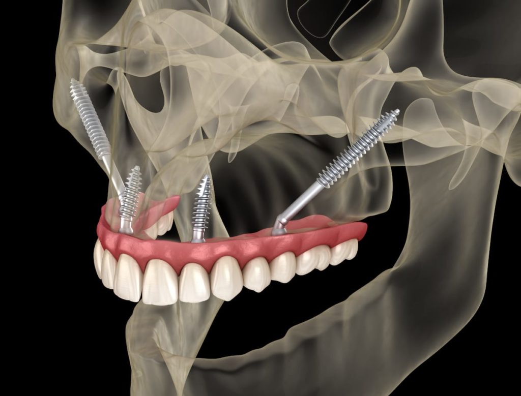 Graftless Zygomatic Dental Implants