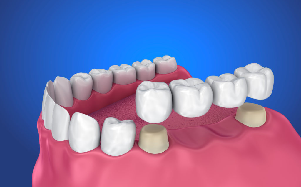 Tooth supported fixed bridge