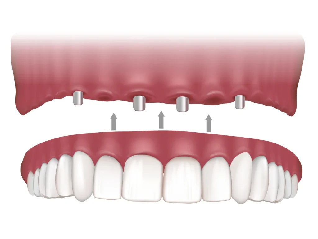 Diagram of overdentures