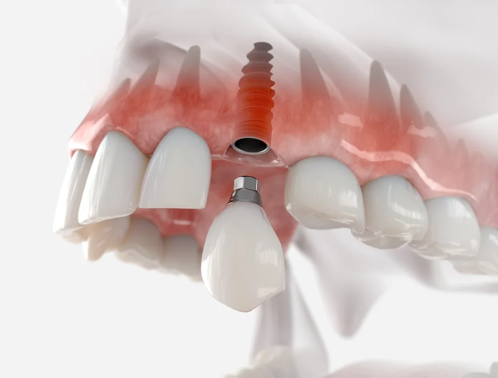 Diagram of zirconia implant